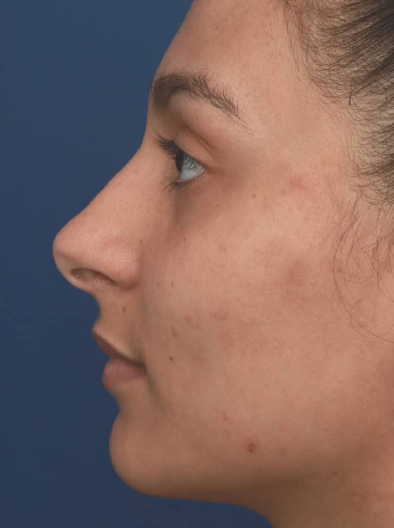 Before Image: Ethnic Rhinoplasty - left-side