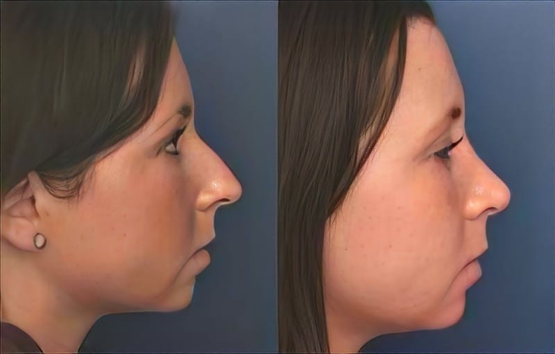 Rhinoplasty Surgery Baltimore