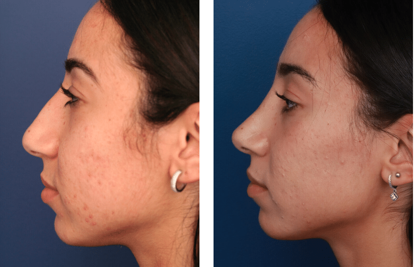 Ethnic Rhinoplasty Baltimore