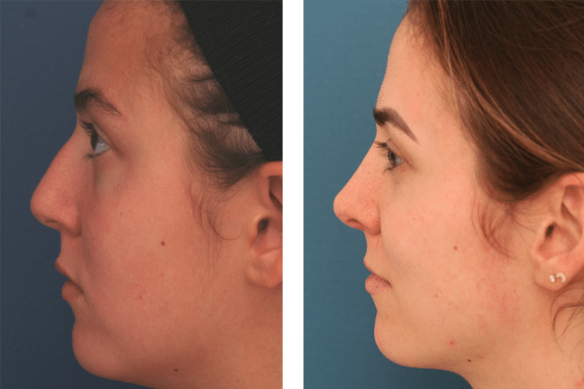 profile view of before and after rhinoplasty