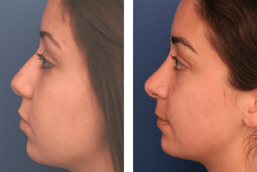 profile view of before and after rhinoplasty