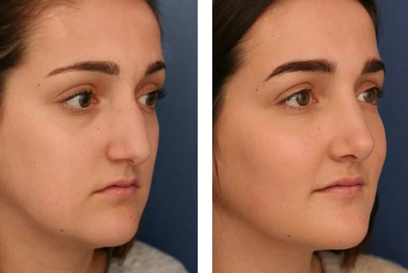 three quarter view of before and after rhinoplasty