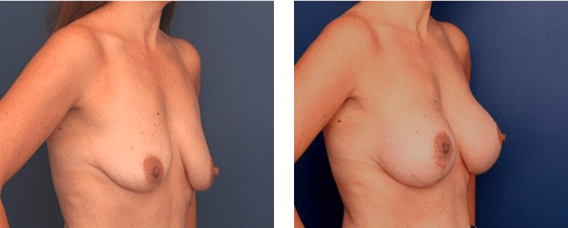 three qurater view of before and after breast lift with augmentation