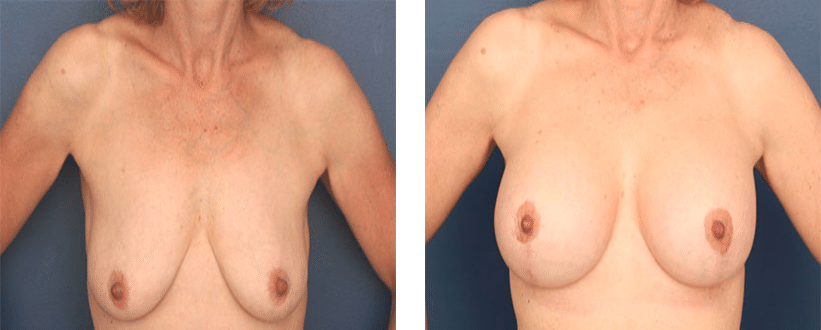 front view of before and after breast lift with augmentation
