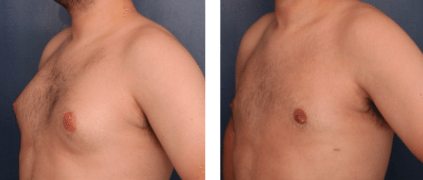 three quarter view of before and after gynecomastia