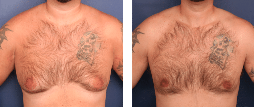 forward view of before and after gynecomastia
