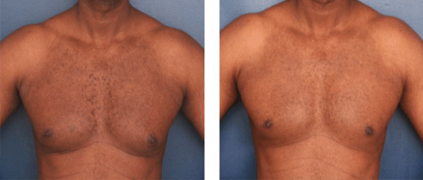 forward view of before and after gynecomastia