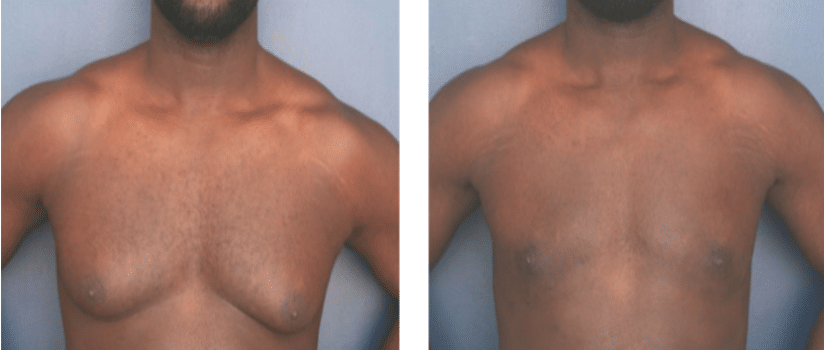 forward view of before and after gynecomastia