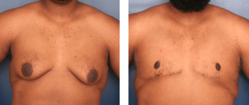 forward view of before and after gynecomastia