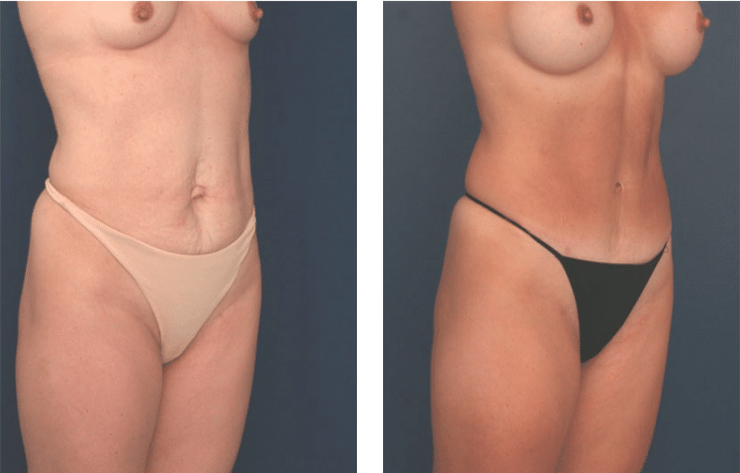three quarter view of before and after tummy tuck