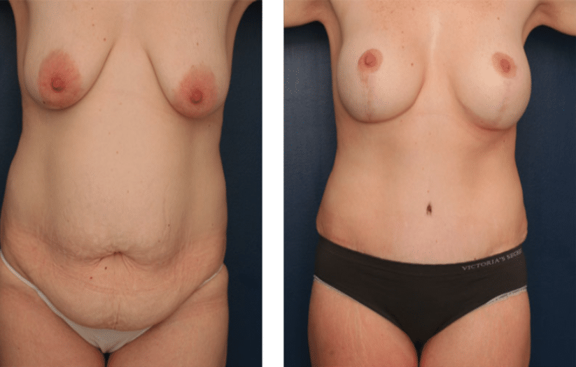 front view of before and after tummy tuck