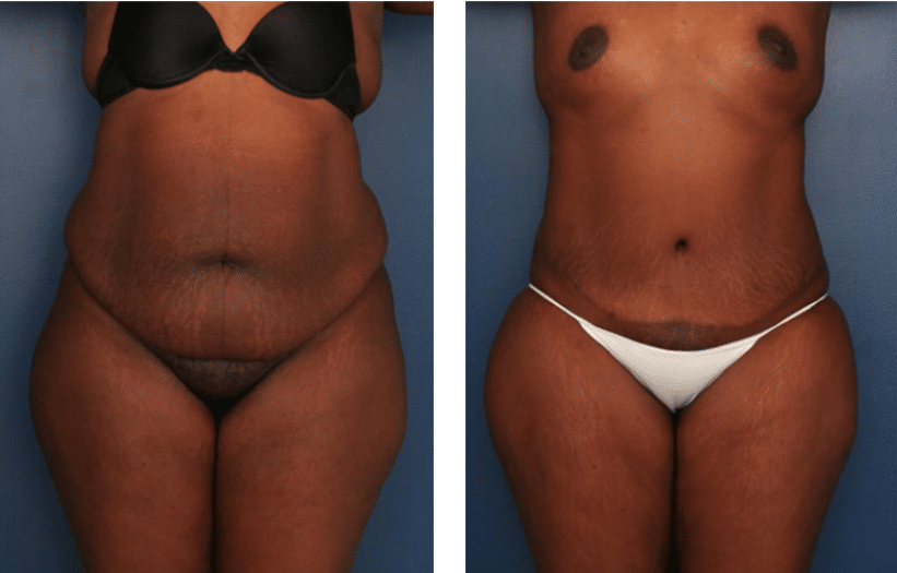 front view of before and after tummy tuck