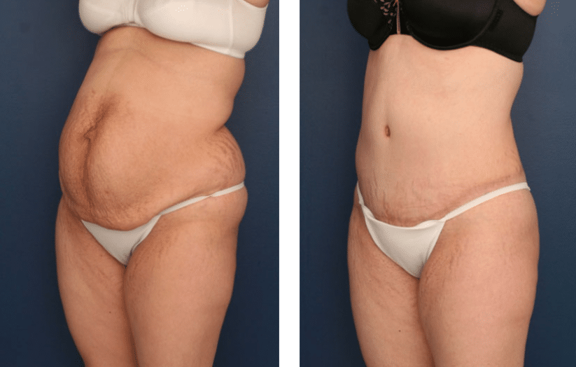 three quarter view of before and after tummy tuck