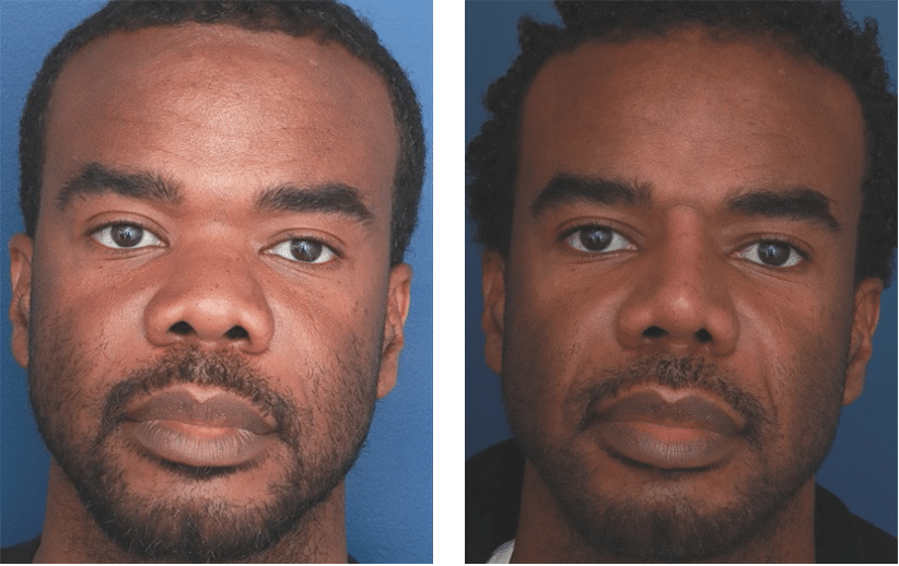Nose surgery Baltimore