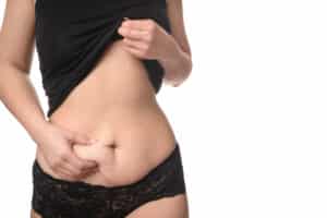 Woman showing the loose skin on her stomach after massive weight loss from Ozempic.