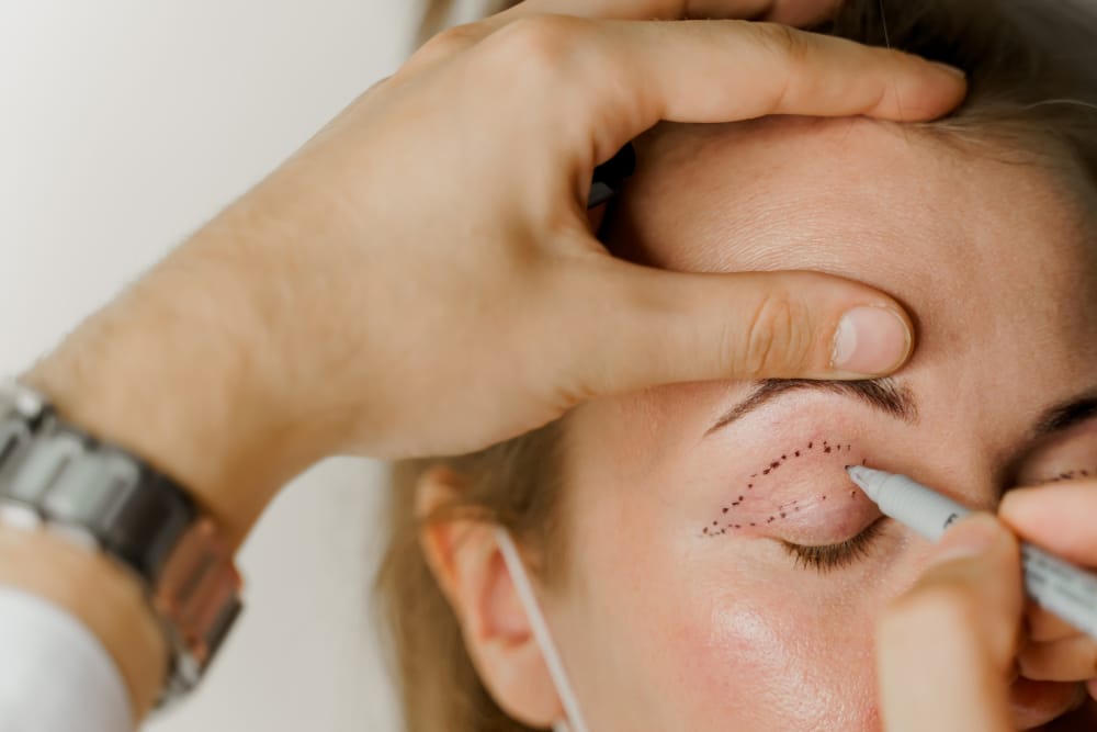 Blepharoplasty Baltimore