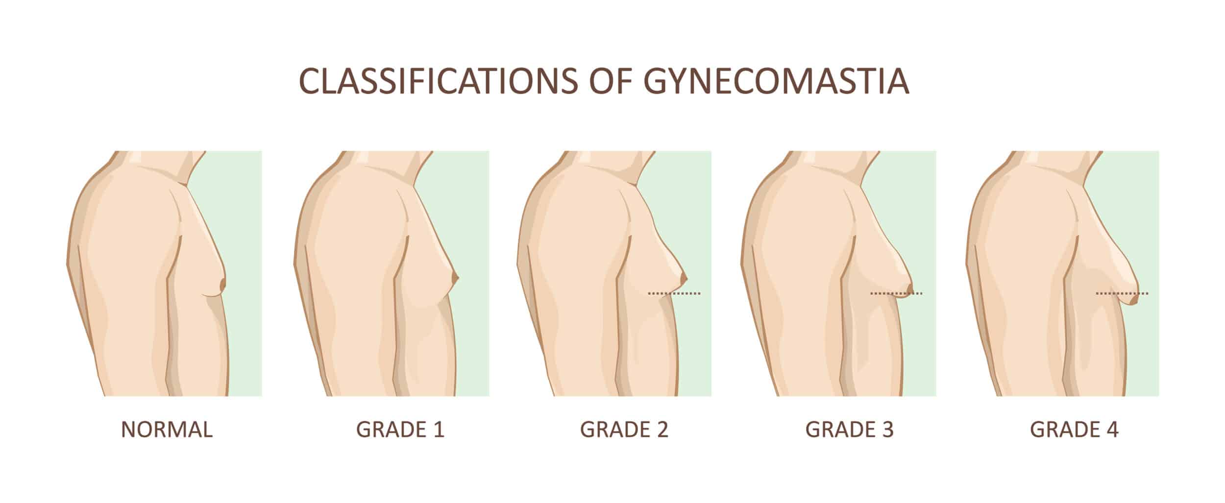 Grades and Types of Gynecomastia Maryland