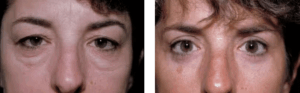 Before and after images of woman who had eyelid surgery showing drastic improvement