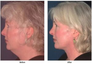 Side-by-side photos showing mature woman's side profile before her neck lift and after, with a beautiful new neck contour.