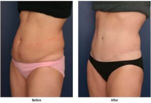 Before and after image of woman who has had a tummy tuck.
