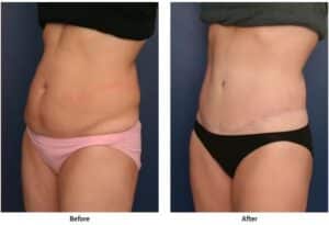 Before and after image of woman who has had a tummy tuck.