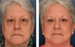 Before and after photos of woman who's had lower eyelid surgery, showing drastic improvement in under eye bags and dark circles