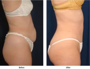 Before and after photos showing a woman's results after a tummy tuck procedure
