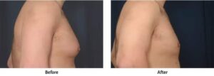 Before and after images of a man's chest after successful male breast reduction surgery for gynecomastia.