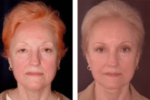 Before and after images showing woman's results after eyelid surgery