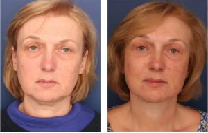 Side-by-side before and after photos of a middle-aged woman showing results of a combined facelift and neck lift.
