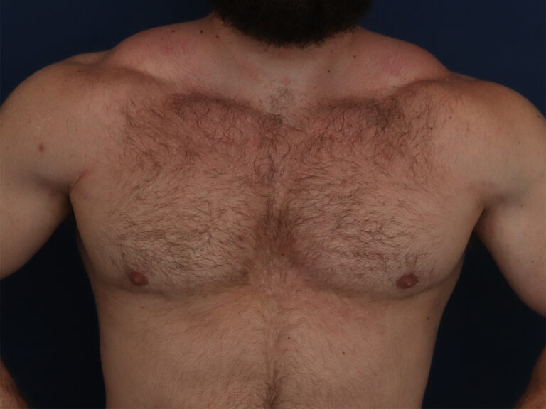 After Image: Gynecomastia - front