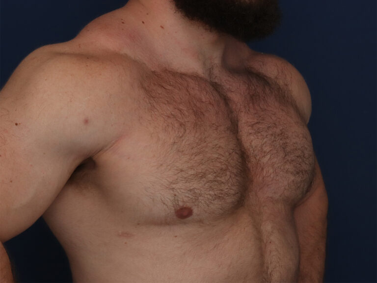 After Image: Gynecomastia - right-front-oblique