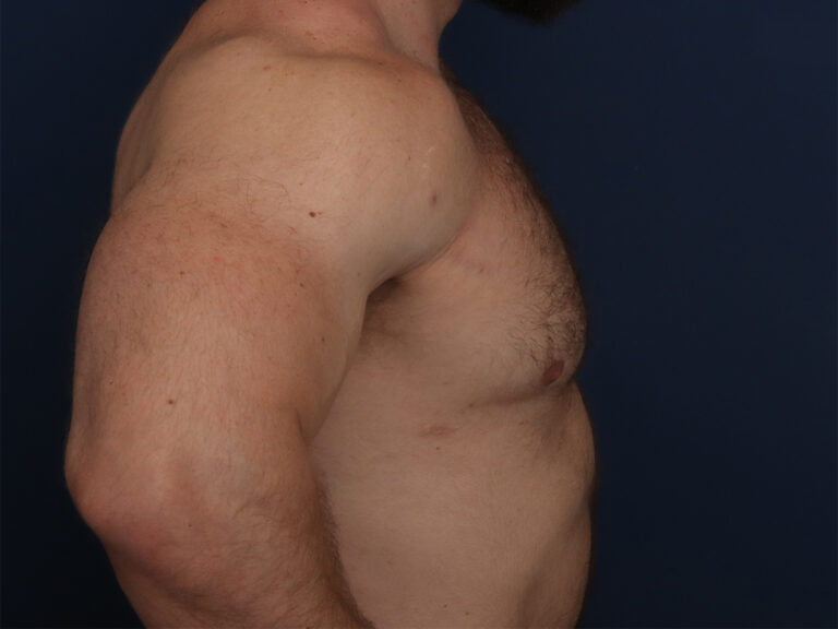 After Image: Gynecomastia - right-side