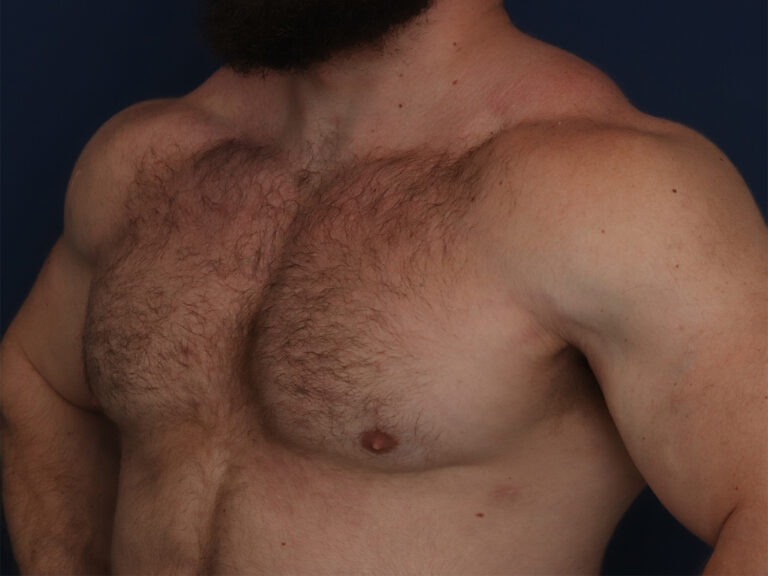 After Image: Gynecomastia - left-front-oblique