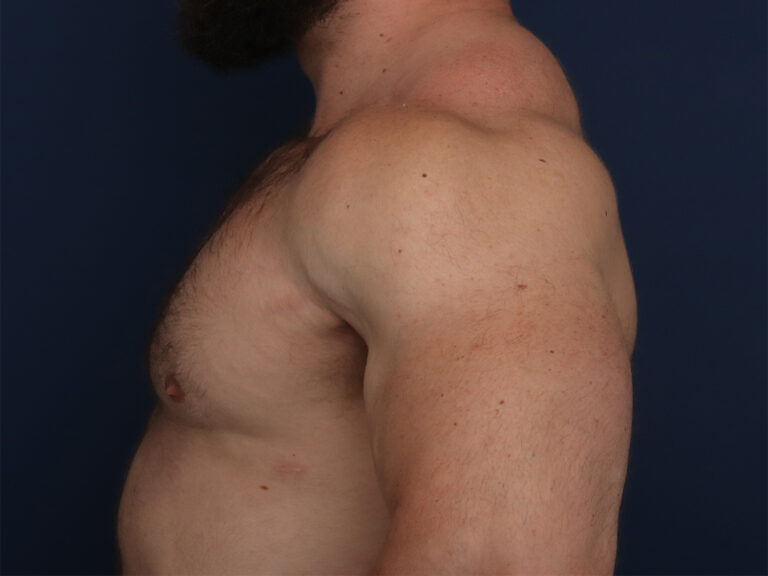 After Image: Gynecomastia - left-side