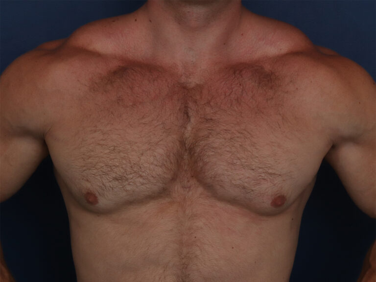 Before Image: Gynecomastia - front