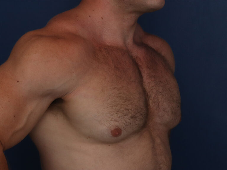Before Image: Gynecomastia - right-front-oblique