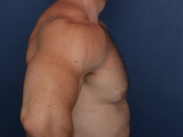 Before Image: Gynecomastia - right-side