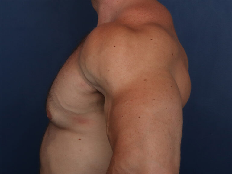 Before Image: Gynecomastia - left-side