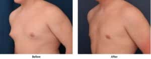 Before & after image showing successful male breast reduction results