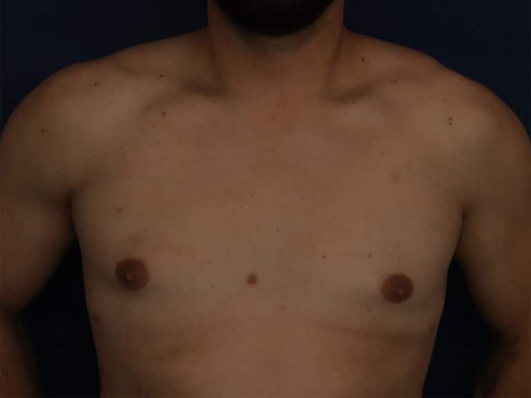 After Image: Gynecomastia - front