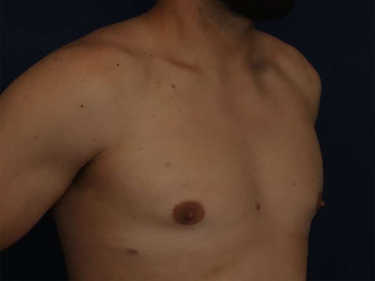 After Image: Gynecomastia - right-front-oblique