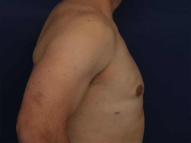 After Image: Gynecomastia - right-side