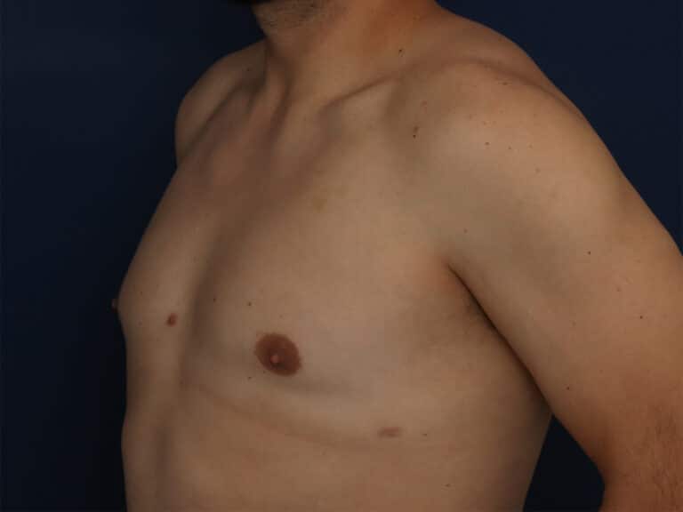 After Image: Gynecomastia - left-front-oblique