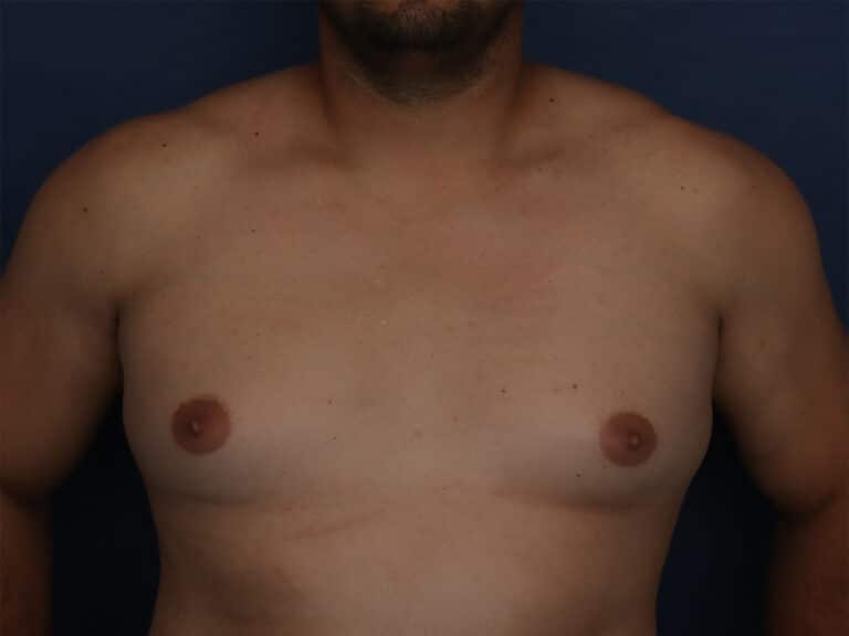 Before Image: Gynecomastia - front