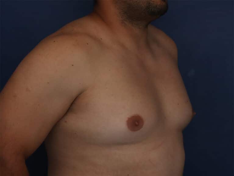 Before Image: Gynecomastia - right-front-oblique