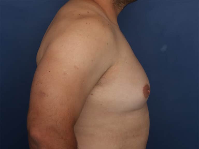 Before Image: Gynecomastia - right-side