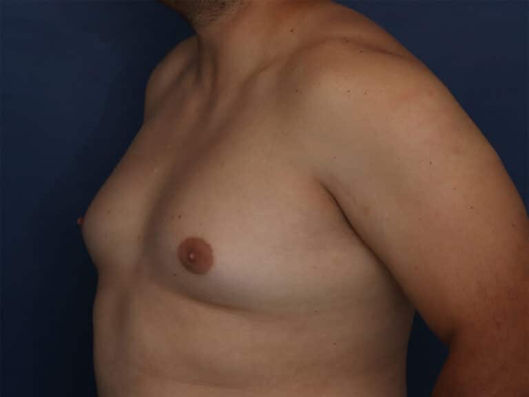 Before Image: Gynecomastia - left-front-oblique