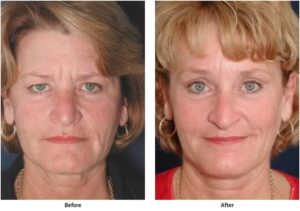 Before and after photos showing a woman's results after getting a brow lift that makes her look friendlier and more alert.