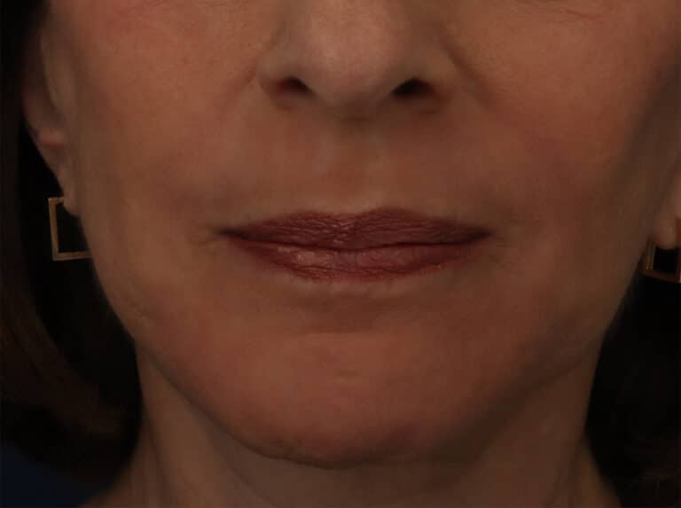 After Image: Laser Resurfacing - front
